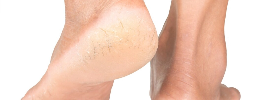 Popraskané päty a suchá koža