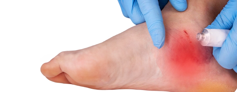 Diabetická starostlivosť o nohy