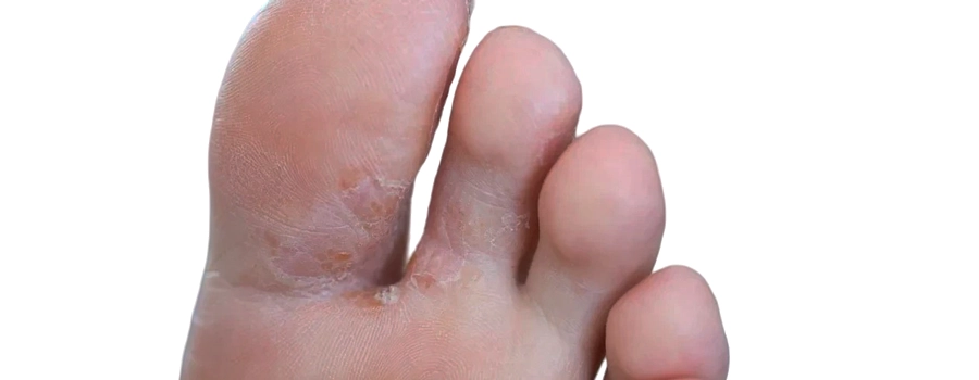 Mykózy nôh a nechtov