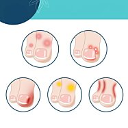 Gélová ochrana prstov pred odreninami a pľuzgiermi