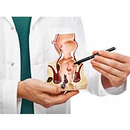 Prierezový model konečníka, hemeroidy (zväčšený) s patológiami