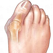 Chránič na malíček s gélovým klinom, 7 x 1cm,1ks