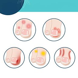 Gélová ochrana prstov pred odreninami a pľuzgiermi - Náhľad