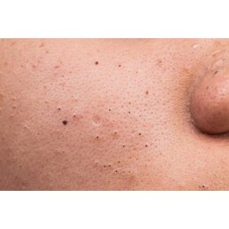 Kozmetický nástroj na odstraňovanie čiernych bodiek a akné - Náhľad