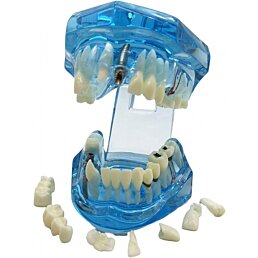 Model chrupu, zubných implantátov - Náhľad