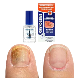 Roztok na mykózou oslabené nechty, Onykoleine - 10 ml - Náhľad