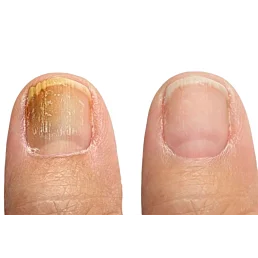 PACT UREA 40 reparátor na nechty - domáca sada na ošetrenie mykózy - Náhľad