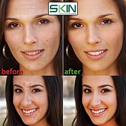 Sada nástrojov na čistenie, vytláčanie a odstránenie akné v puzdre so zrkadlom - Náhľad