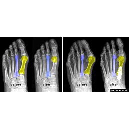 Dlaha na korekciu vykriveného palca, výrastkov a pľuzgierov halux - biela 2ks - Náhľad