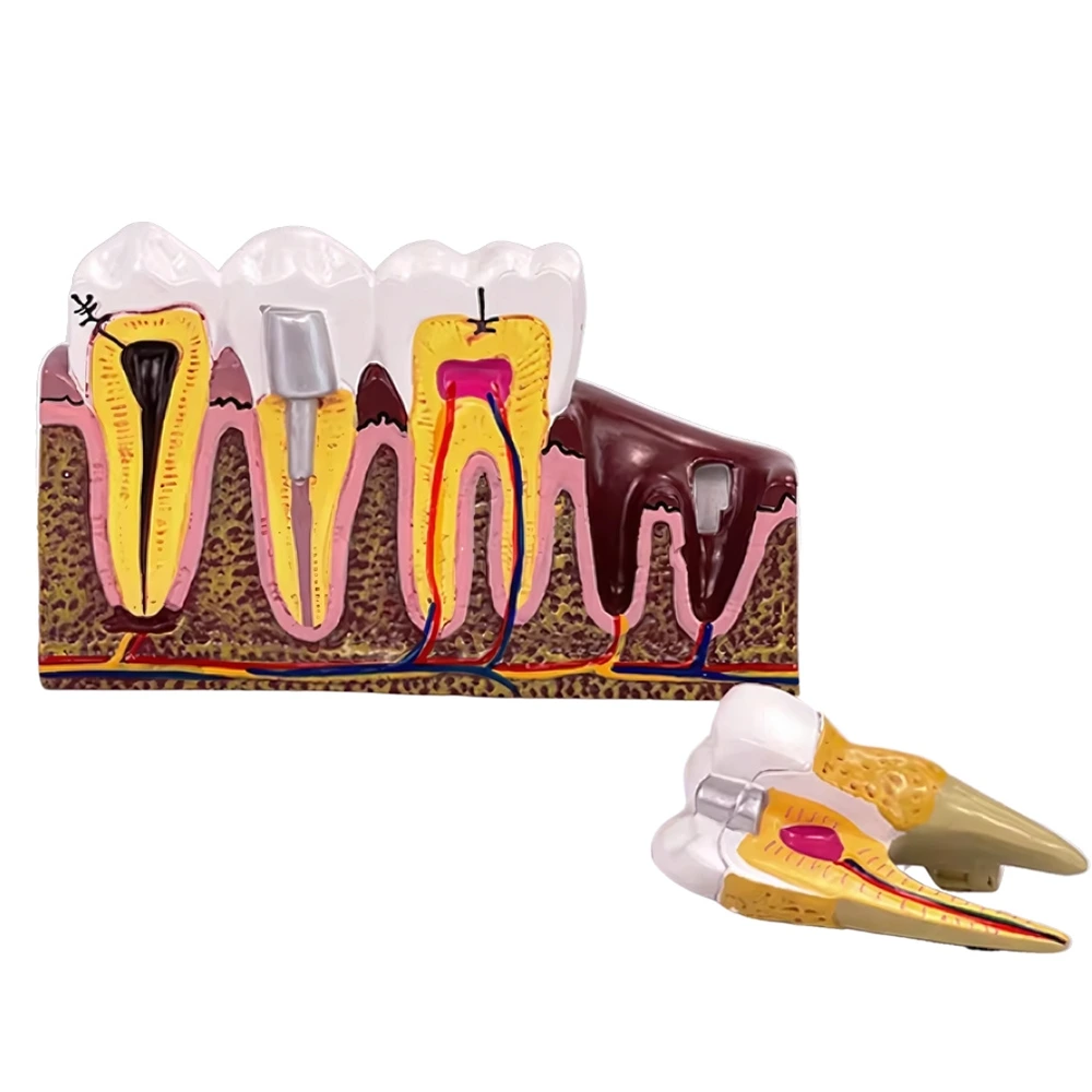 Anatomický model zuba priečny rez so zobrazenými patológiami