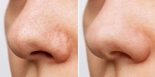 Bezdrôtový ultrazvukový peeling na tvár