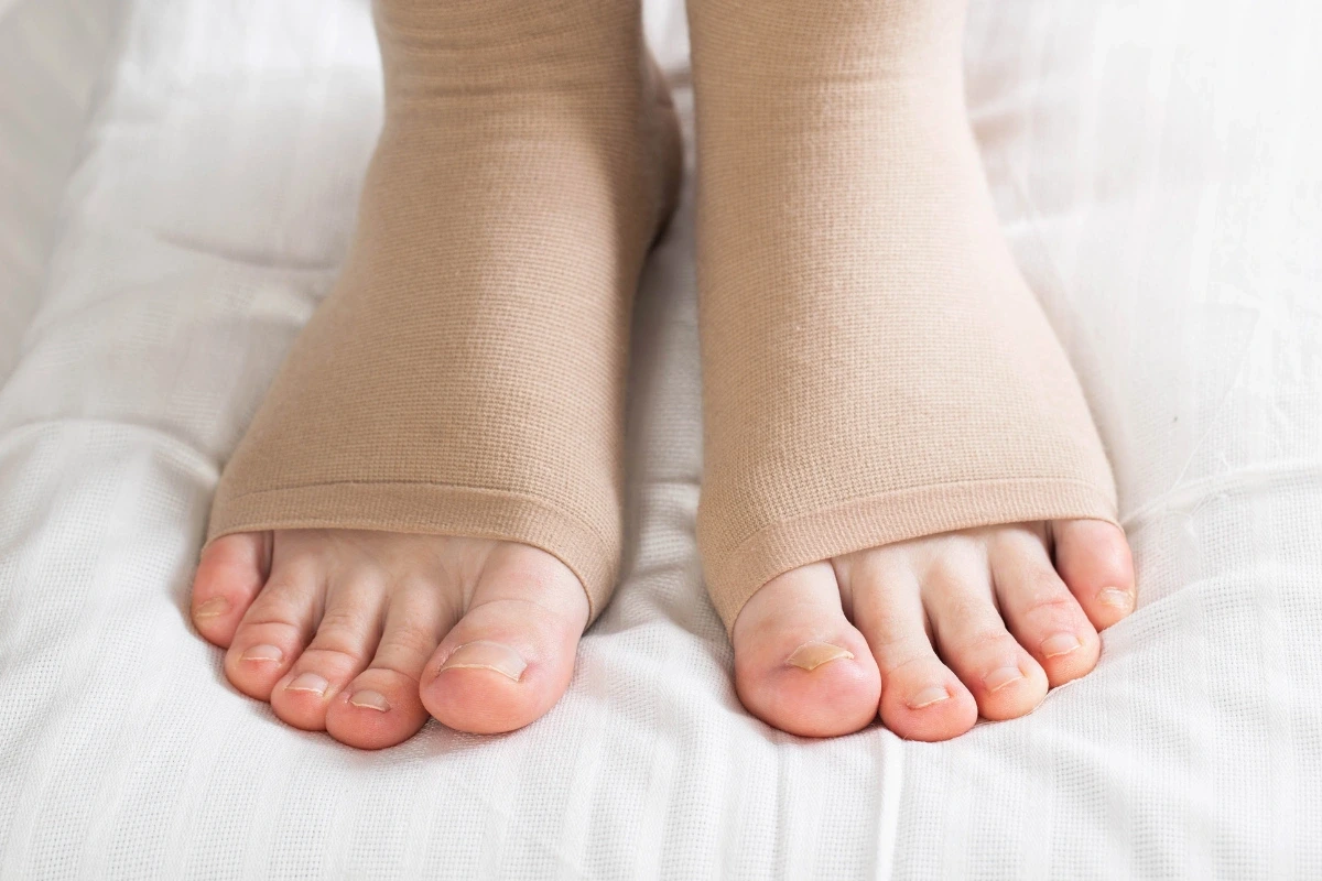 Nohy v béžových kompresných návlekoch s otvorenou špičkou.