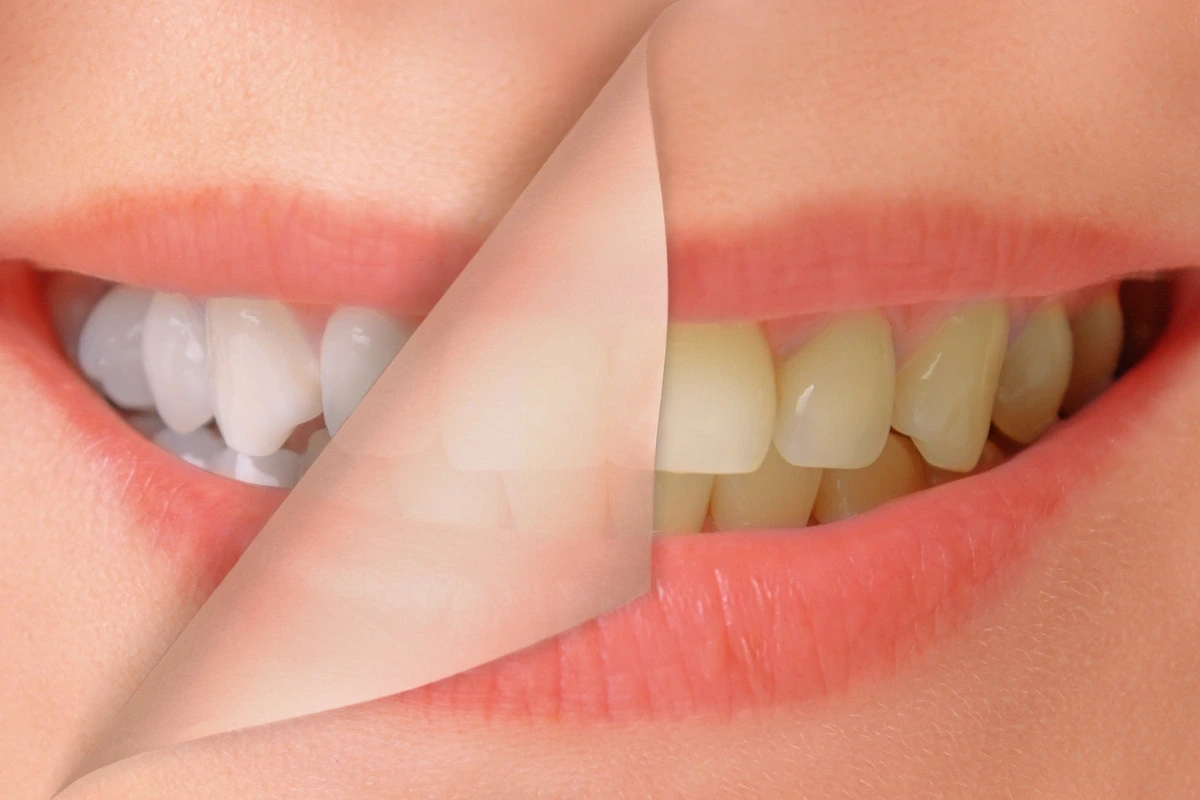 Grafické porovnanie žltých a bielych zubov ako symbol prevencie zažltnutia.