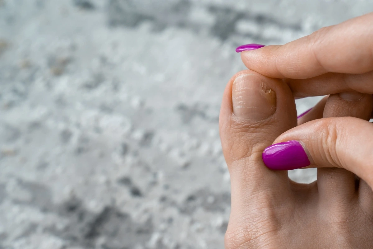 Ženská noha s príznakmi mykózy nechtov na palci.