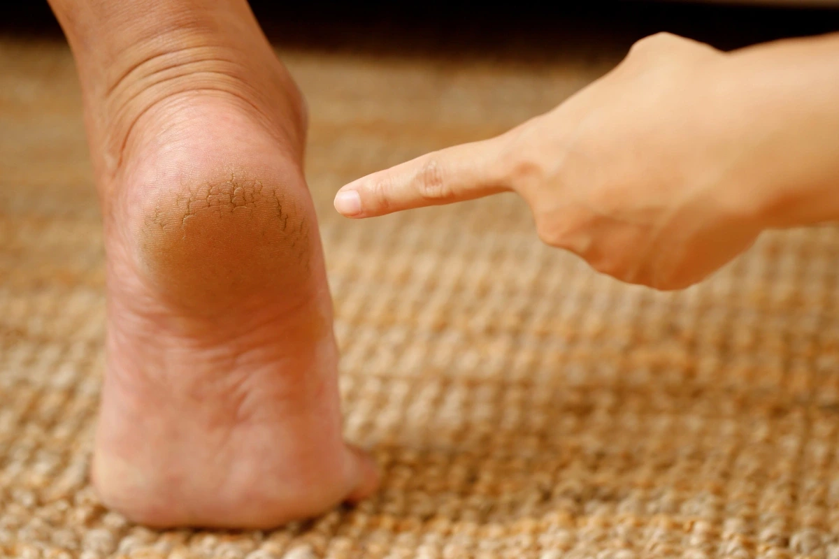 Popraskaná a zrohovatená koža na päte s prstom ukazujúcim na postihnutú oblasť.
