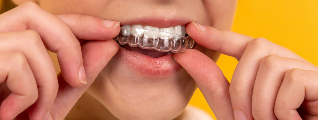 Žena si nasadzuje dlahu určenú na bielenie zubov.